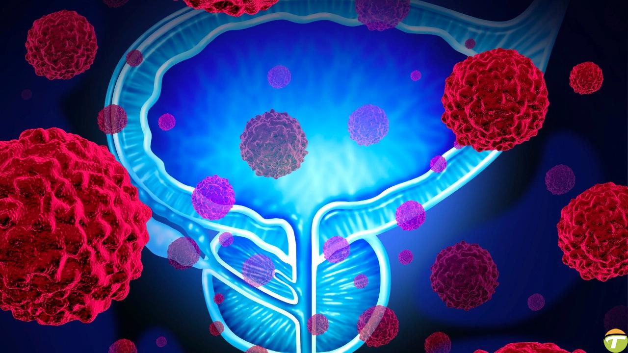 erkeklerin prostat kanserine bu kadar fazla yakalanmasinin sebebi nedir hele de 40 yasini gectiyse CTlup2Kp