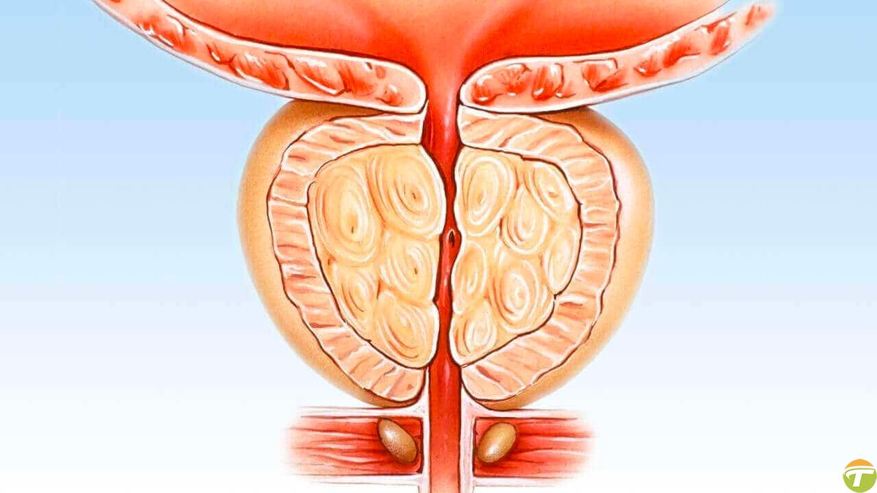 erkeklerin prostat kanserine bu kadar fazla yakalanmasinin sebebi nedir hele de 40 yasini gectiyse DtZVKbrK